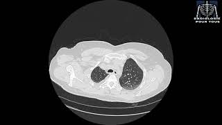 SCANNER THORACIQUE  Pleurésie bilatérale déjà traité pour TBK pulmonaire [upl. by Mamie285]