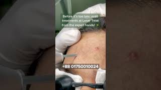 Acne Treatment  Dhaka Dermatology Institute  LaserTreat [upl. by Echo969]