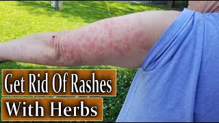 Foraging Wild Herbs To Get Rid of Rashes [upl. by Crissie]