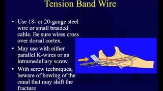 Olecranon Fractures [upl. by Dolan]