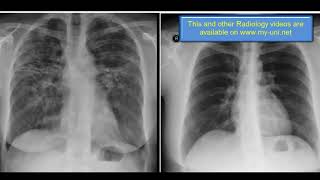 Chest Xray  ILD Fibrosis Traction bronchiectasis Sarcoidosis  by hammadshams [upl. by Etteniuqna311]