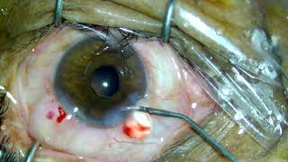 cataract with posterior synechiae [upl. by Neyr]