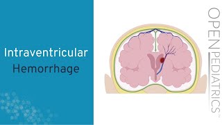 Intraventricular hemorrhage IVH of the newborn [upl. by Wade]