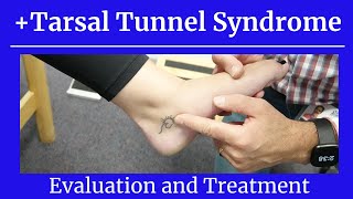 Positive Tarsal Tunnel SyndromeEval and Treatment [upl. by Teuton]