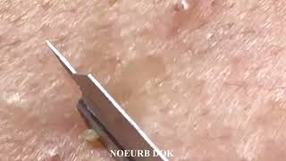 Popping Tons Of Blackheads Part 04 [upl. by Liew166]