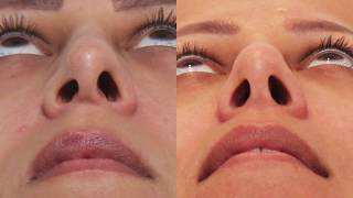 Revision Rhinoplasty Asymmetrical Nostrils [upl. by Nayek81]