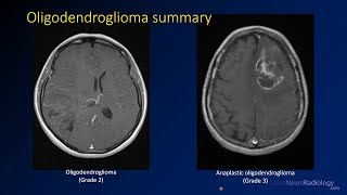 Imaging brain tumors  3  Oligodendrogliomas [upl. by Riess]