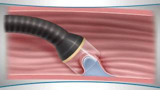 What is endoscopic mucosal resection [upl. by Vannie]