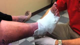 Treatment of an Ulcer with an Unna Boot [upl. by Freddy]