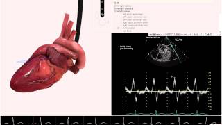 HeartWorks Multilobed Left Atrial Appendage [upl. by Nanji]