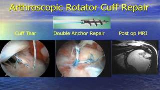 Sports Medicine Update 2010 Rotator Cuff Injuries Presented by Dr Stephan Yacoubian [upl. by Nations808]