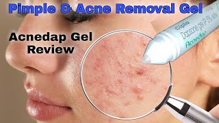 Acne amp Pimple Ke Liye Best Acnedap Gel Review in Hindi  Uses and Benefits of Acnedap Gel [upl. by Ayerdna288]