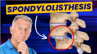 Spondylolisthesis 4 Exercises to Reduce Pain Demo on Real Patient [upl. by Castillo175]