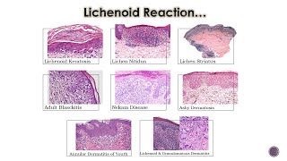 8 Lichenoid Dermatoses 2 [upl. by Woermer]