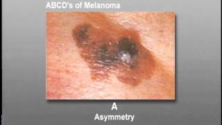 How To Identify Skin Cancer [upl. by Hellene]