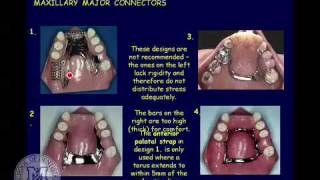 DENT 718 Classification and components of removable partial dentures [upl. by Eronaele]