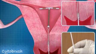 Intra Uterine Device IUD Copper T Animation  ADMAA [upl. by Son]