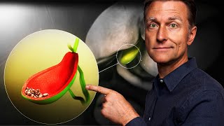 Gallbladder Removal Surgery  Vital Things to Know MUST WATCH [upl. by Perice]