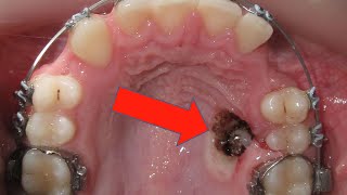 🤔HOW BRACES WORK Amazing TRANSPOSITION canines and premolars🦷  timelapse Episode 4 [upl. by Nat]