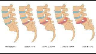 Physiotherapy management for Lumbar spondylolisthesis StayHome and study WithMe [upl. by Notxap]