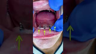 The dental prosthesis on implant dentalimplant mrdent viral [upl. by Nulubez334]