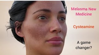 Melasma New Medicine  Cysteamine  Is it a game changer melasma melasmacream melasmatreatment [upl. by Esinaej]