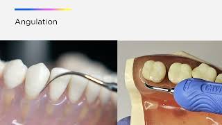 Optimize your Cavitron® Ultrasonic Technology The Three A’s of Ultrasonic Instrumentation [upl. by Neeven269]