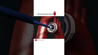 Aortic dissection Stent grafting cardiology shorts [upl. by Aicittel]