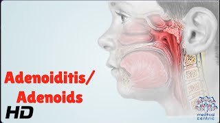 AdenoiditisAdenoids Everything You Need To Know [upl. by Rubin]