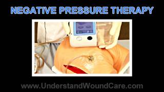 Negative Pressure Therapy Part 1 of 4 Understand Wound Care [upl. by Feigin]