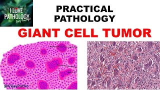 GIANT CELL TUMOR BONE Pathogenesis Clinical features amp Morphology [upl. by Niko789]