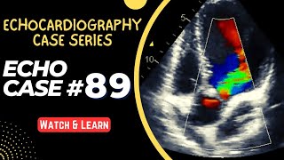 ECHO CASE 89  Echocardiography Case Series  Echocardiogram Interpretation  2D Echo Basics [upl. by Janenna355]