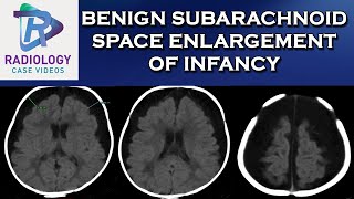 Benign Subarachnoid Space enlargement of infancy [upl. by Ecinwahs]