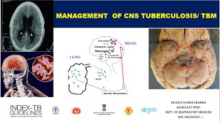 Management of CNS TuberculosisTB Meningitis NTEP Guidelines [upl. by Odinevneib837]