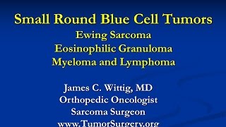 Orthopedic Oncology Course Small Round Blue Cell Tumors Ewing Sarcoma Lymphoma  Lecture 8 [upl. by Milzie]