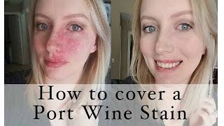 How to cover a Port Wine Stain birthmark [upl. by Sil596]