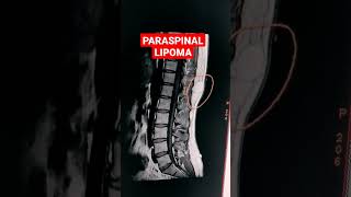 Paraspinal Lipoma mri shorts mriradiographer MRI Dorso Lumbar Spine  T1W Sequence [upl. by Lenard]