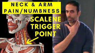 NECK amp ARM pain Relief Scalene Muscle Trigger Points [upl. by Ayotna]