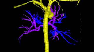 Imaging of aortopulmonary collateral arteries with highresolution multidetector CT [upl. by Kyne]