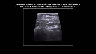 Fullthickness tear of the infraspinatus tendon on shoulder ultrasound case 2 [upl. by Odranar812]