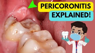 PERICORONITIS EXPLAINED IN 5 MINUTES CAUSE SYMPTOMS DIAGNOSIS AND TREATMENT [upl. by Sadie]