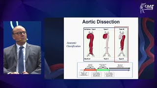 Dissecção aguda de aorta tipo B qual momento de intervir [upl. by Imotih980]
