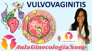 VULVOVAGINITIS Síntomas causas diagnóstico y tratamiento  Ginecología y Obstetricia [upl. by Asinet]