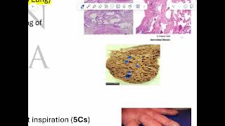 RS pathology 5 restrictive lung diseases [upl. by Ocihc584]