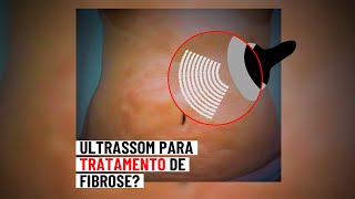 Ultrassom é uma boa opção para o tratamento de fibrose Pergunte 138 [upl. by Newsom]