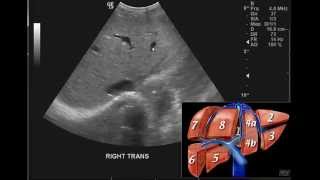 Introduction to the interpretation of Abdominal Ultrasound [upl. by Simonetta]