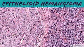 Epithelioid Hemangioma aka ALHE 5Minute Pathology Pearls [upl. by Grega]