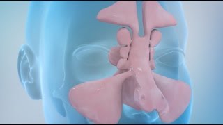 Sinusitis and Sinus Surgery Explained Balloon Sinuplasty and Endoscopic Sinus Surgery [upl. by Hemingway]