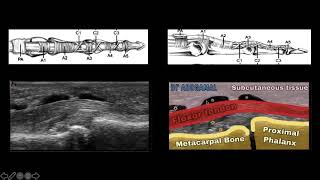 All about DACTYLITIS in Psoriatic arthritis [upl. by Pietro56]