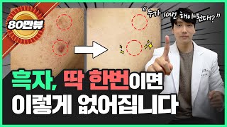 왜 레이저 10번이나 받으세요 흑자 제거는 1번 만에 100 치료되는데😭 힘들게 피부과 왔다 갔다 하지 마세요 [upl. by Hillyer]